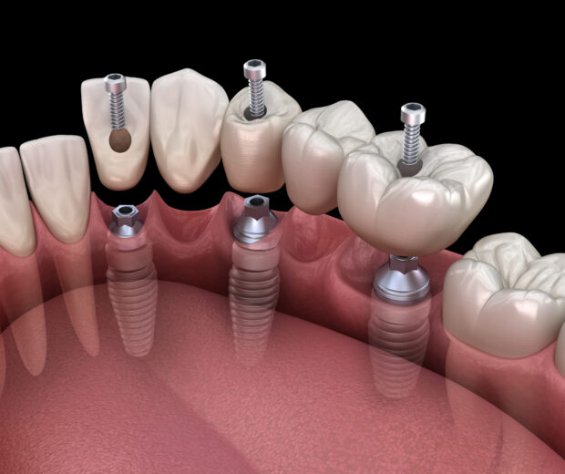 Dental bridge based on 3 implants. Medically accurate 3D illustration of human teeth and dentures concept